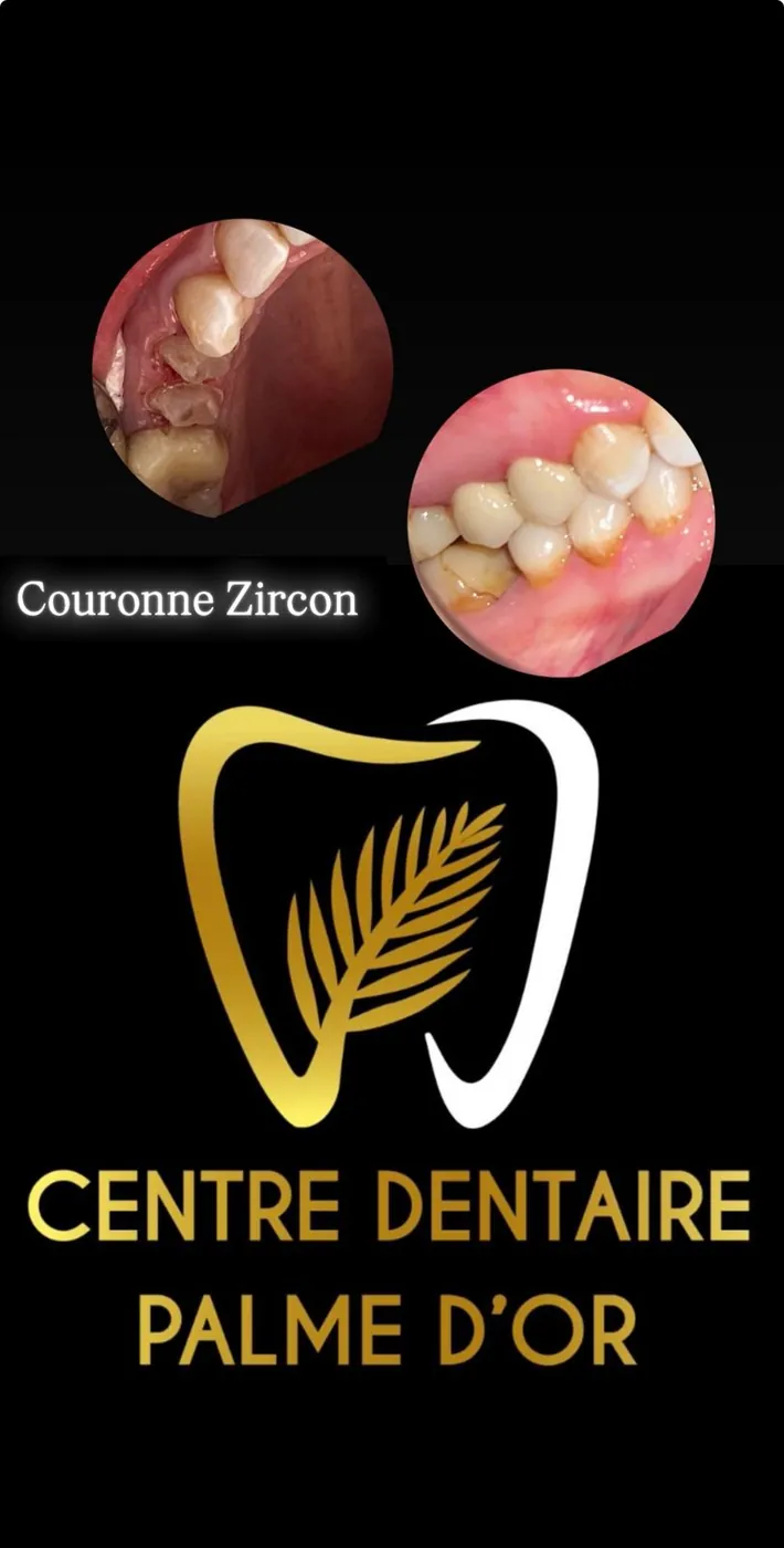 Prix d'un implant dentaire et d'une couronne à Marrakech